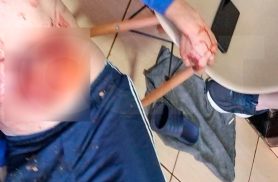 Homem fica com vísceras expostas e agoniza por 50 minutos após acidente com serra mármore