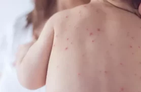 Estado de São Paulo reforça necessidade de vacinação contra o sarampo Estado de São Paulo reforça necessidade de vacinação contra o sarampo