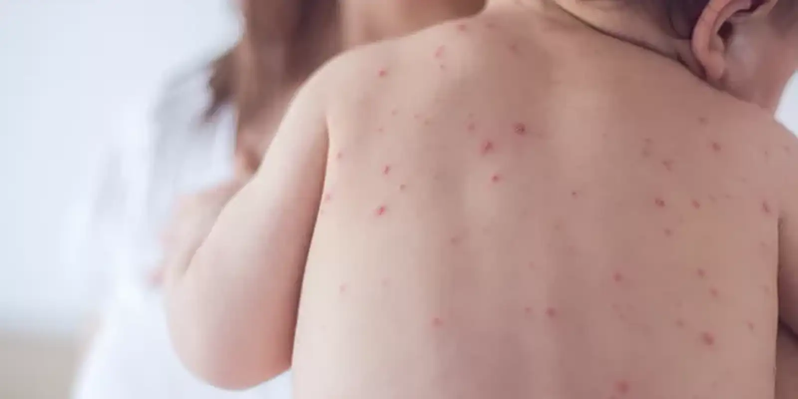 Estado de São Paulo reforça necessidade de vacinação contra o sarampo Imagem referente a Estado de São Paulo reforça necessidade de vacinação contra o sarampo