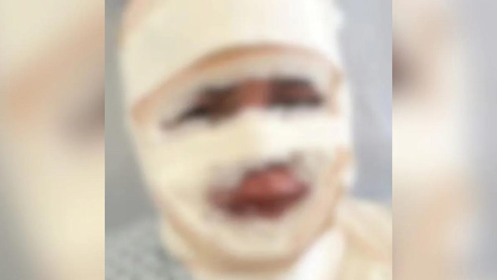 Imagem referente a Fisioterapeuta que jogou água quente em atual do ex é presa