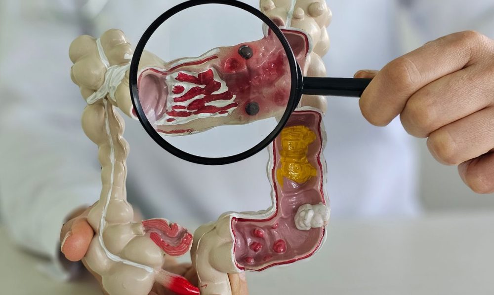 Em 13 anos, doença inflamatória intestinal cresce 5 vezes no Brasil Imagem referente a Em 13 anos, doença inflamatória intestinal cresce 5 vezes no Brasil