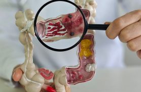 Em 13 anos, doença inflamatória intestinal cresce 5 vezes no Brasil