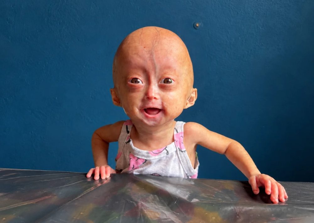 Imagem referente a Morre Elis Lima Carneiro aos 5 anos, influencer mirim com síndrome rara de envelhecimento precoce