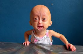 Morre Elis Lima Carneiro aos 5 anos, influencer mirim com síndrome rara de envelhecimento precoce