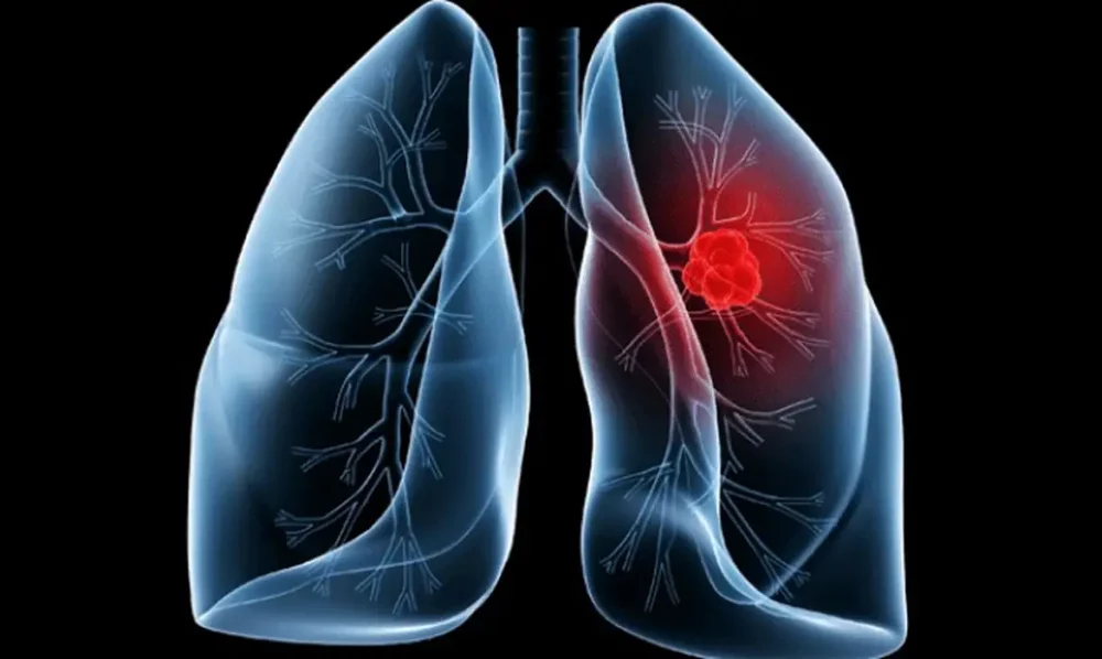Saiba o que é adenocarcinoma pulmonar, câncer que atinge o Papa Leão Imagem referente a Saiba o que é adenocarcinoma pulmonar, câncer que atinge o Papa Leão