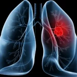 Imagem relativa a Saiba o que é adenocarcinoma pulmonar, câncer que atinge o Papa Leão