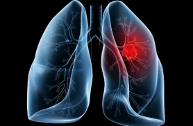 Saiba o que é adenocarcinoma pulmonar, câncer que atinge o Papa Leão