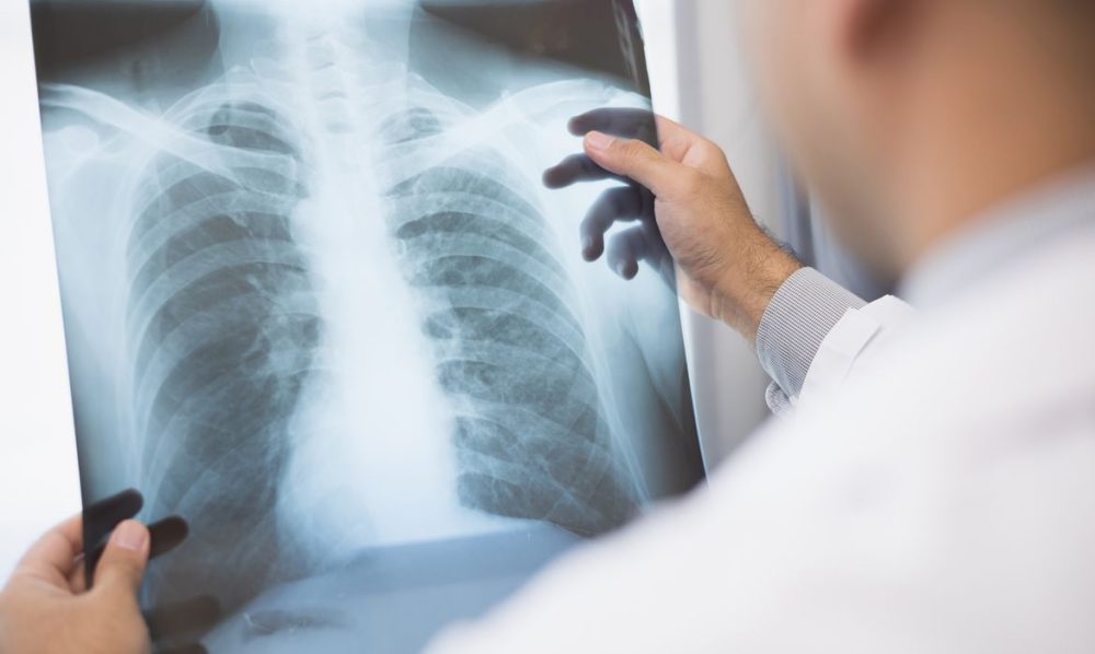 Anvisa aprova novo medicamento para câncer de pulmão avançado Imagem referente a Anvisa aprova novo medicamento para câncer de pulmão avançado